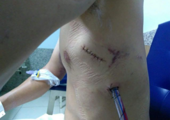 Confira como ficou a cirurgia após esfaqueamento de usuário de drogas